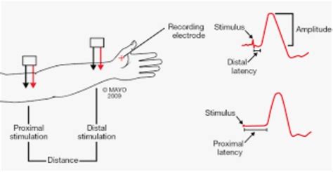 Peroneal Nerve Conduction Study