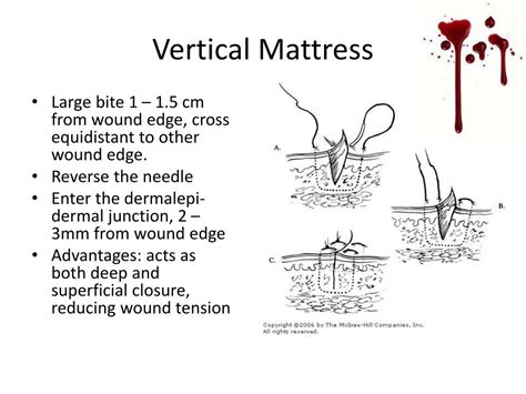 PPT - Suturing Basics PowerPoint Presentation, free download - ID:2156670