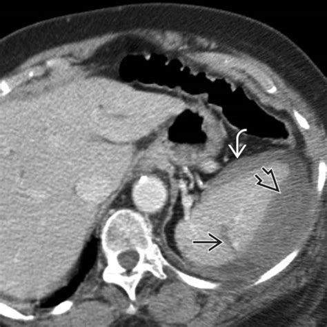 Splenic Trauma | Radiology Key