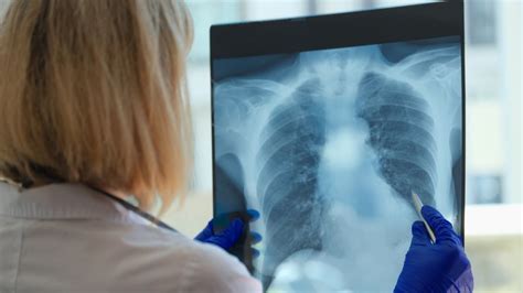 What Is White Lung Syndrome? Know Signs, Symptoms And Preventive Measures Of Mystery Pneumonia