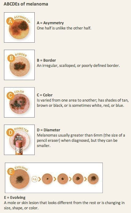 Moles (Nevi) - Curcio Dermatology