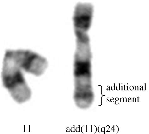 Partial G-banded karyotype of chromosome 11. On the left, is shown the ...