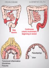 GI-18 Inflammatory Bowel Disease crc flashcards | Quizlet