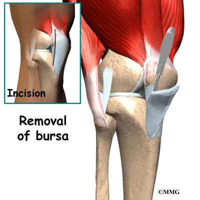 Prepatellar Bursitis | eOrthopod.com