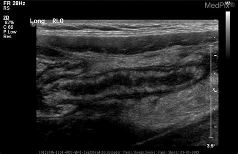 Ruptured Appendix Ultrasound