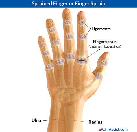 Sprained Thumb or Skier's Thumb|Types|Causes|Signs|Symptoms|Treatment|Exercises