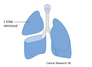 Surgery for Lung Cancer - Risks, Recovery, Survival rate - Sutured