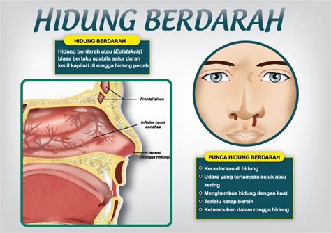 Hidung Kakak Berdarah (Hidung Berdarah & Rawatannya) | Darling Ninie