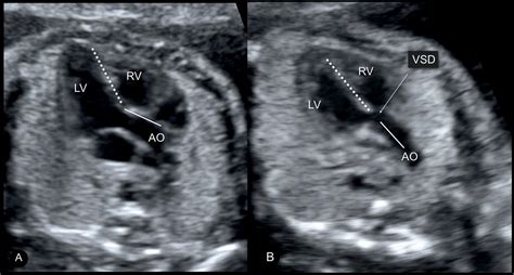 Tetralogy of Fallot, Pulmonary Atresia with Ventricular Septal Defect, and Absent Pulmonary ...