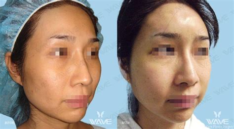 Facial Fat Transfer in Los Angeles | Wave Plastic Surgery