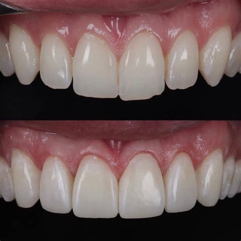 Composite Veneers Sydney | Dental Bonding Sydney | Cosmetic Dentist