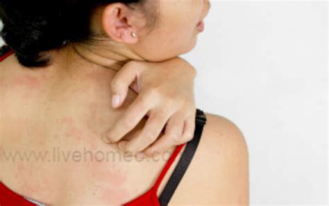 Skin Allergies Prevention Tips – Live Homeo