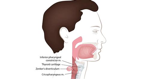 ECE-Lesson 2f2-Pathology of Esophagus-Zenker's diverticulum - YouTube