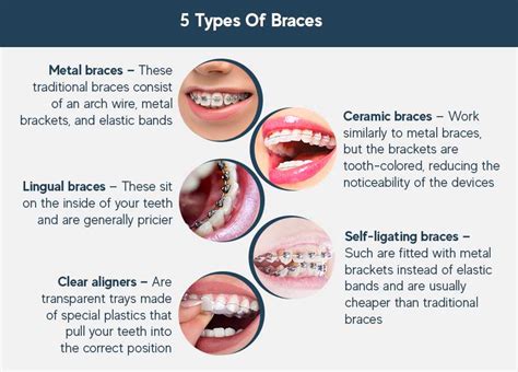 How Do Braces Work? Types, Materials, and Time to Start Working