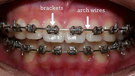 How Do Braces Work On Crowded Teeth - TeethWalls