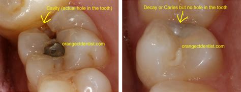 Zoom teeth whitening vs laser - lasinet