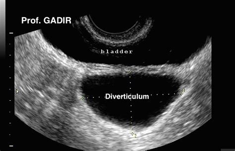 Diverticulum Of Bladder Ultrasound