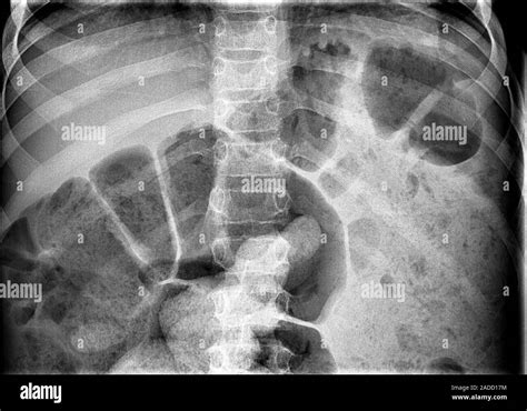 Bowel obstruction, X-ray. The image shows dilatation of the large bowel and massive faecal ...