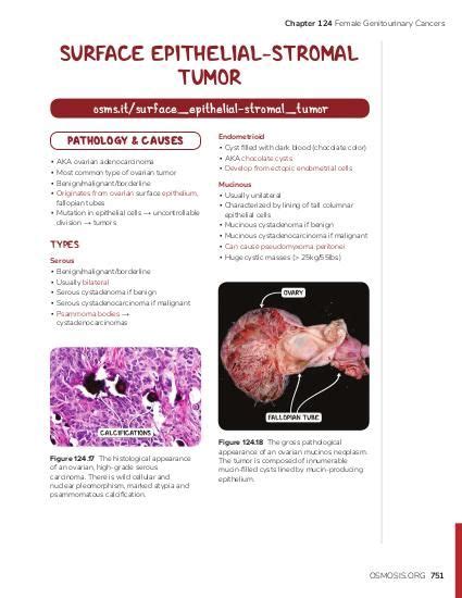 Sex cord-gonadal stromal tumor | Osmosis