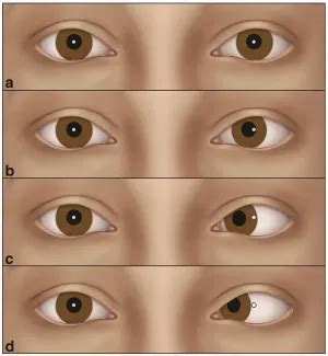 Corneal light reflex - American Academy of Ophthalmology