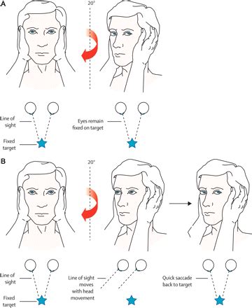 Northland Ear Nose and Throat: Head thrust test- an important test for vertigo.