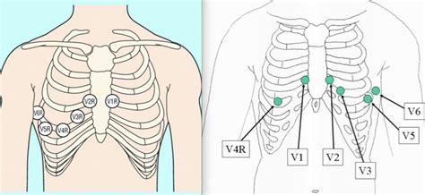 EKG — Blog — NUEM Blog