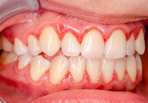 What Is Gingivitis? Your Guide To Your Gums | General Dentistry Texas