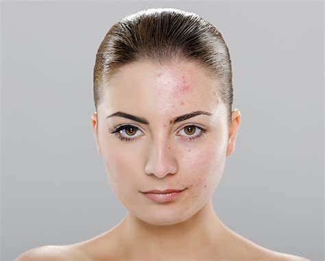 Vitalize Chemical Peels Reverse Signs of Aging Skin