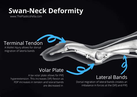 Swan Neck Deformity vs Boutonnières | Deformed, Swan, Neck