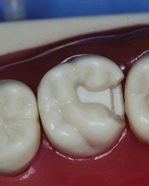 A 15-Minute Direct Class II Composite Technique: Supragingival Restorative Principles ...