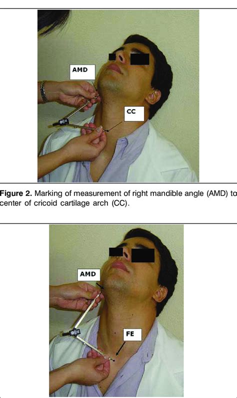 Marking of measurement of right mandible angle (AMD) to left angle (AME). | Download Scientific ...