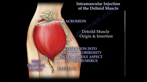 Intramuscular injection of the deltoid muscle - Everything You Need To Know - Dr. Nabil Ebraheim ...