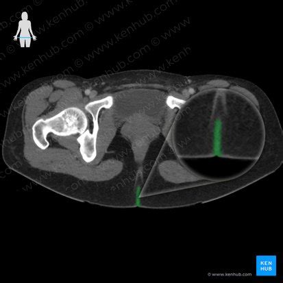 Intergluteal cleft: surface anatomy, location, features | Kenhub