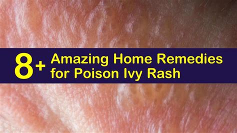 8+ Amazing Home Remedies for Poison Ivy Rash