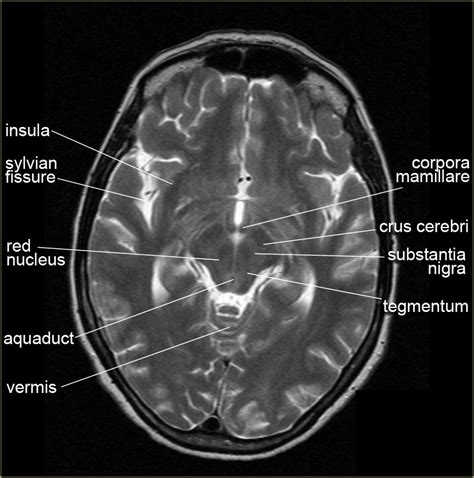 Brain Anatomy On Mri - Anatomical Charts & Posters