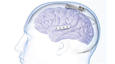 Neurostimulation therapy startup NeuroPace closes $33M raise with extra ...