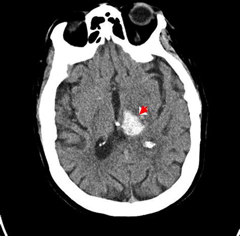 Intracranial Hemorrhage - Cause, Symptoms, Diagnosis, Treatment