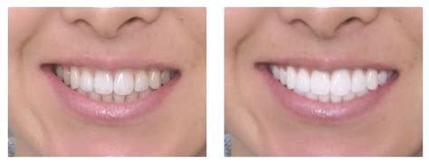 Coconut Oil Teeth Whitening How to Whiten Teeth with Coconut Oil How Long Results Instructions