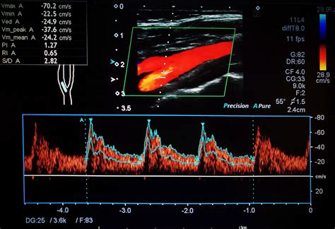 Carotid Stenosis Common in Patients Presenting With Stroke, TIA - Neurology Advisor