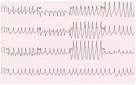 Afib With Rvr Treatment