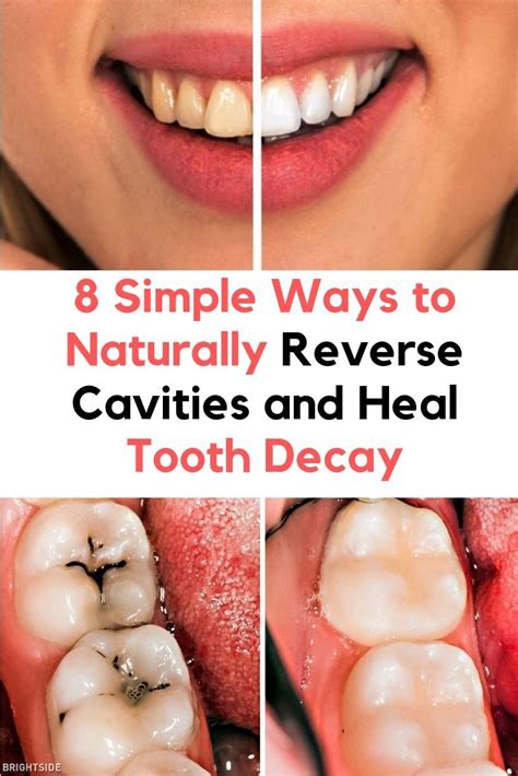 8 Simple Ways to Naturally Reverse Cavities and Heal Tooth Decay | Heal cavities, Reverse ...