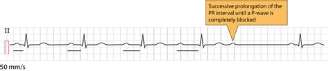 Second-degree AV block: Mobitz type 1 (Wenckebach) & Mobitz type 2 block – EKG & ECHO
