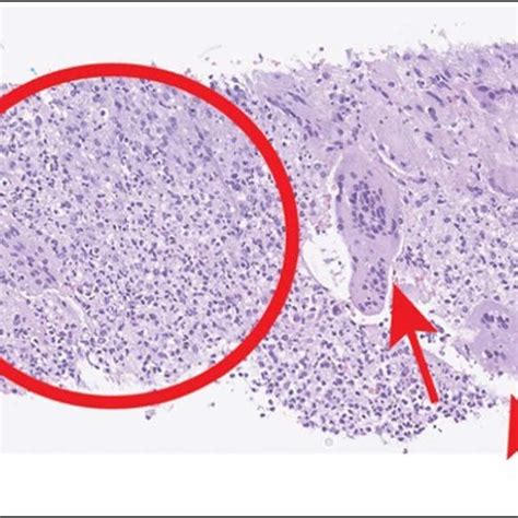 Chronic fibrinopurulent exudate (represented by the circle) and... | Download Scientific Diagram