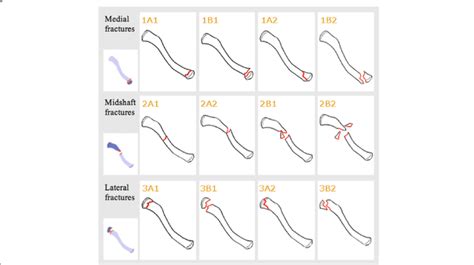 Robinson's classification system for clavicle fractures as presented in... | Download Scientific ...