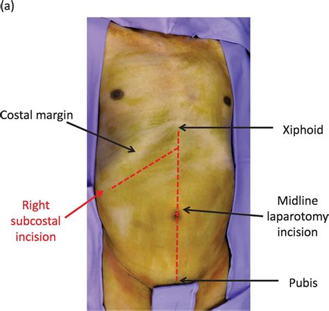 Abdominal incision and abdominal anatomy