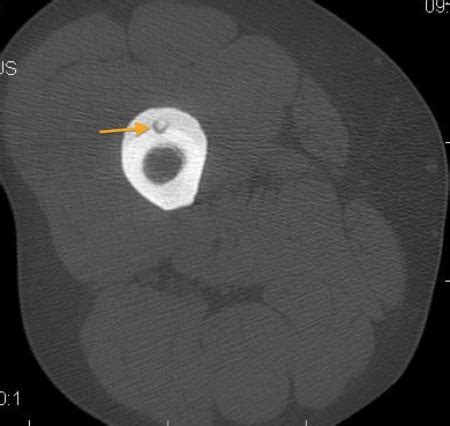 Osteoid osteoma - Radiology at St. Vincent's University Hospital