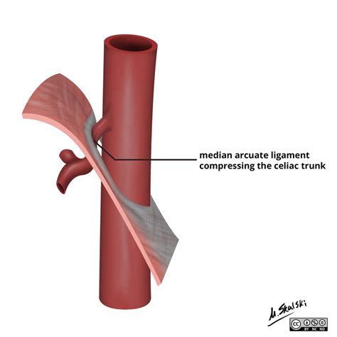 http://radiopaedia.org/cases/median-arcuate-ligament-syndrome-5 | Radiology, Medical anatomy ...