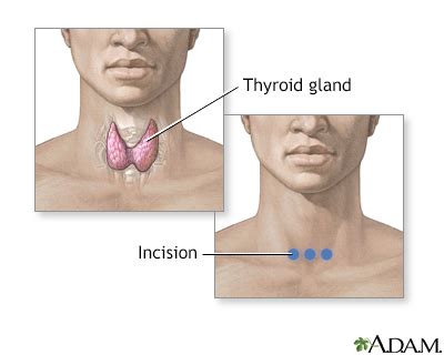 Thyroid gland removal Information | Mount Sinai - New York