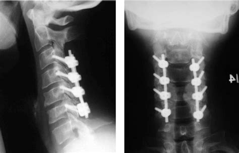 Posterior Cervical Fusion | Reno Orthopedic Center