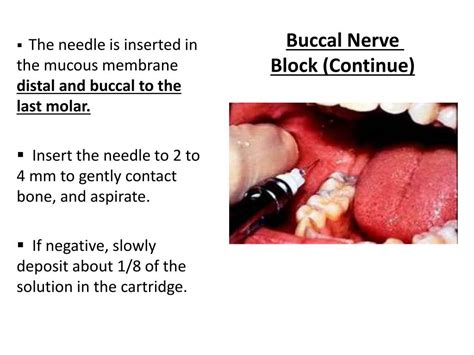 Buccal Nerve Block Technique